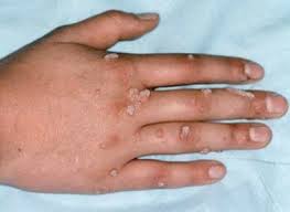 Mẹo trị mụn cơm, mụn cóc hiệu quả tại nhà